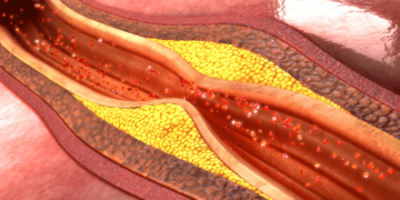 جلوگیری از حملات قلبی با تجزیه پلاک‌ های خونی با نانوذرات