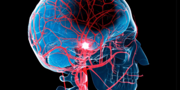 ارتباط قهوه، آبمیوه و نوشیدنی های گازدار با خطر سکته مغزی