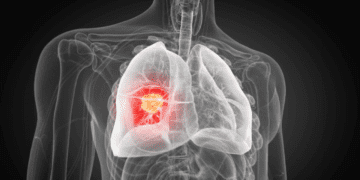 زیرشاخه جدیدی از سرطان ریه در بیماران غیرسیگاری کشف شد
