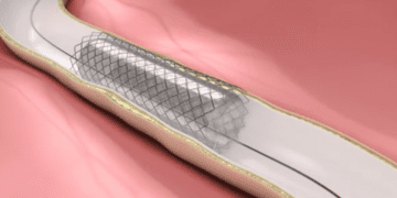 حسگر جدیدی برای استنت‌های صفراوی ساخته شد