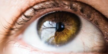 بازگرداندن بینایی بیماران LSCD با سلول‌های بنیادی انسانی