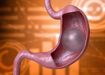 کاهش 60 درصدی مصرف غذا با بالنهای معده جدید