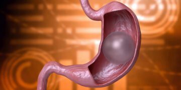 کاهش 60 درصدی مصرف غذا با بالن‌های معده جدید