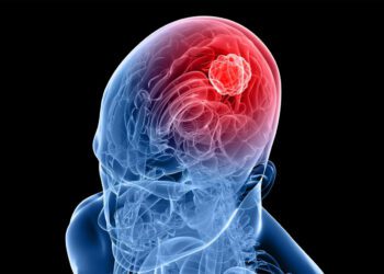 این فناوری جدید گلیوبلاستوما و ام‌اس را درمان می کند