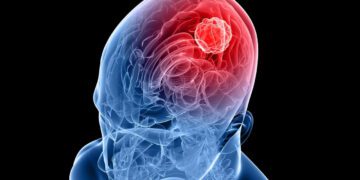 این فناوری جدید گلیوبلاستوما و ام‌اس را درمان می کند