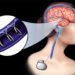 استارتاپ NeuroBionics: انقلابی در درمان بیماری‌های عصبی با فناوری نوین زیست‌الکتریکی