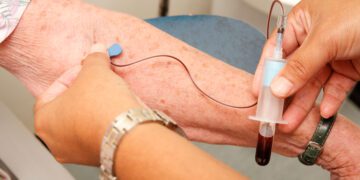 تشخیص دقیق بیماری آلزایمر با یک آزمایش خون ساده