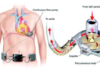 کاشت پمپ قلب مکانیکی جدید برای درمان نارسایی قلبی