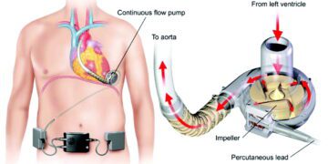 کاشت پمپ قلب مکانیکی جدید برای درمان نارسایی قلبی