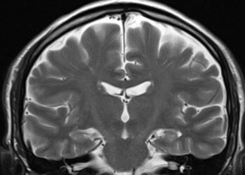 افزایش شیوع آنفولانزا و آسیب مغزی آن در کودکان