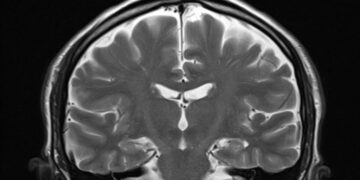 افزایش شیوع آنفولانزا و آسیب مغزی آن در کودکان