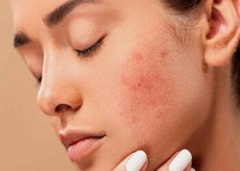 علت بروز جوش و آکنه در بزرگسالی چیست؟