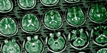 کشف ناهنجاری‌ های پنهان در عملکرد مغز سربازان