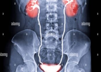 نخستین پیوند موفقیت‌آمیز مثانه انسانی در آمریکا انجام شد