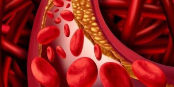 از کجا بفهمیم چربی خون بالا داریم؟