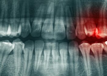 ترکیب ورزش و امگا ۳ شدت عفونت مزمن ریشه دندان را کاهش می‌ دهد