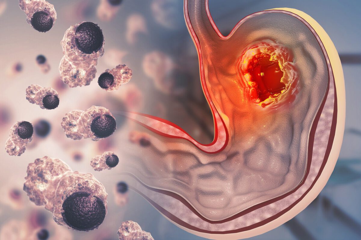 ۷۵ درصد از موارد سرطان معده با روشی ساده قابل پیشگیری هستند