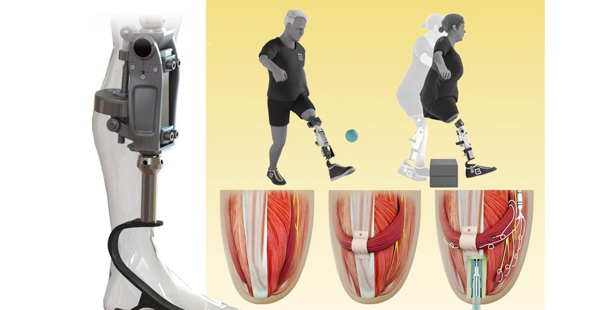 زانوی مصنوعی محققان MIT توان حرکتی افراد قطععضو را بازیابی می کند