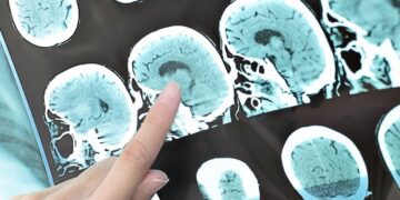 این مدل هوش مصنوعی جدید سکته مغزی را سریع‌ و دقیق‌ تشخیص می‌ دهد