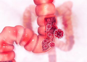 روشی جدید برای تشخیص سرطان روده بزرگ با دقت ۹۰ درصدی