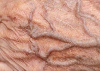 کووید-۱۹ می تواند روند پیری عروق خونی را تا پنج سال تسریع کند