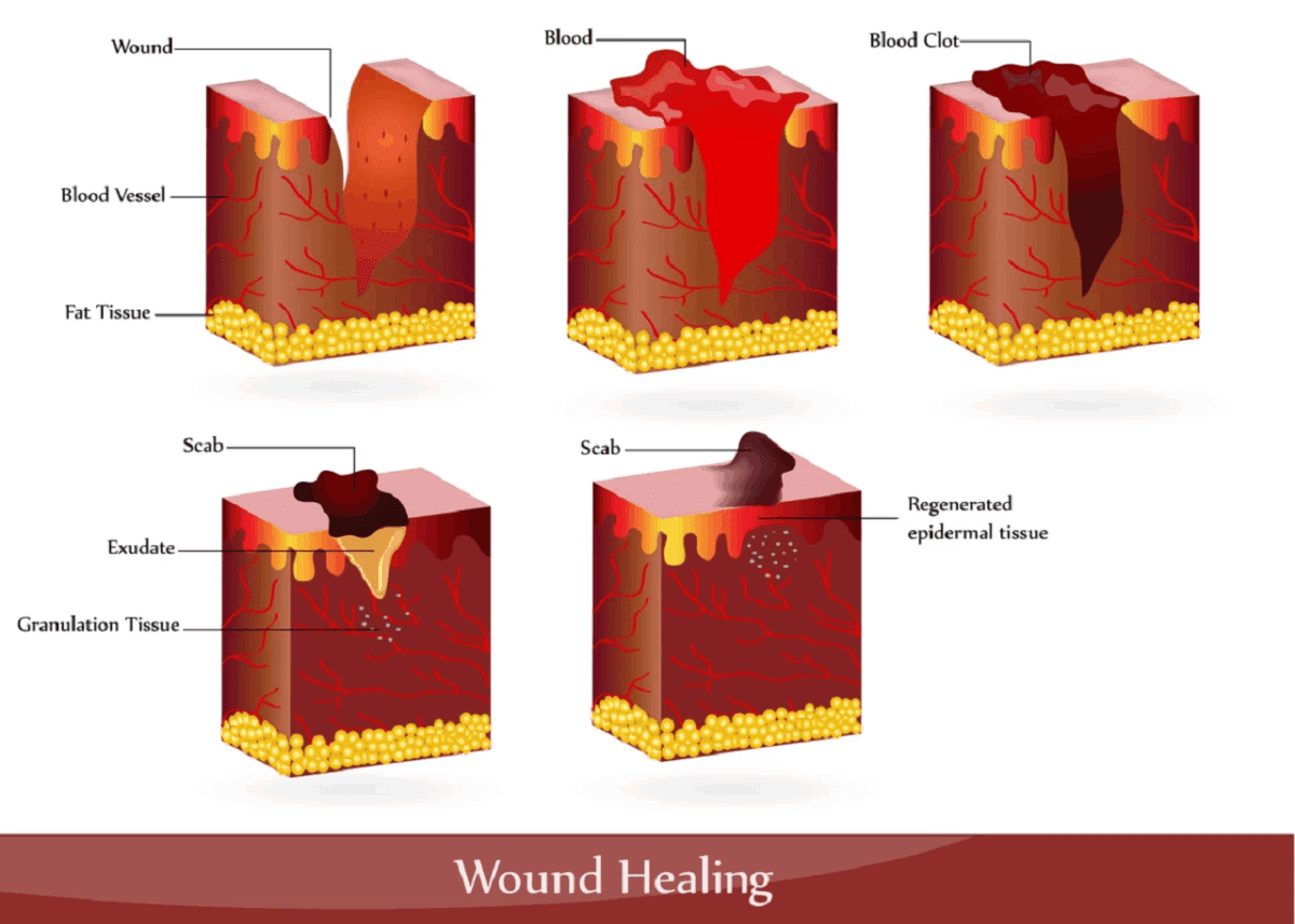 مراحل بهبود زخم