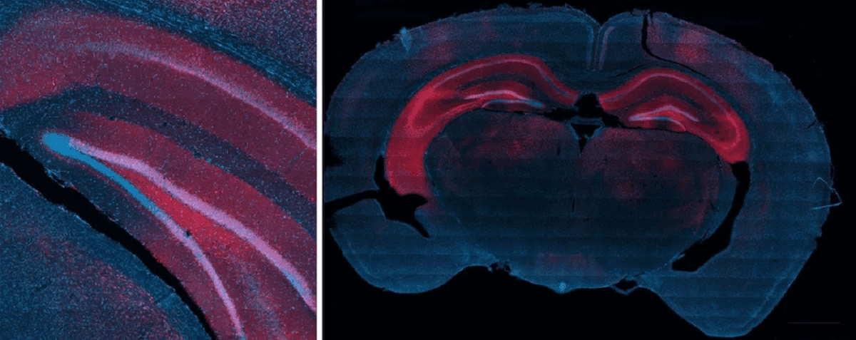 کنترل تشنج با امواج صوتی و ژن درمانی
