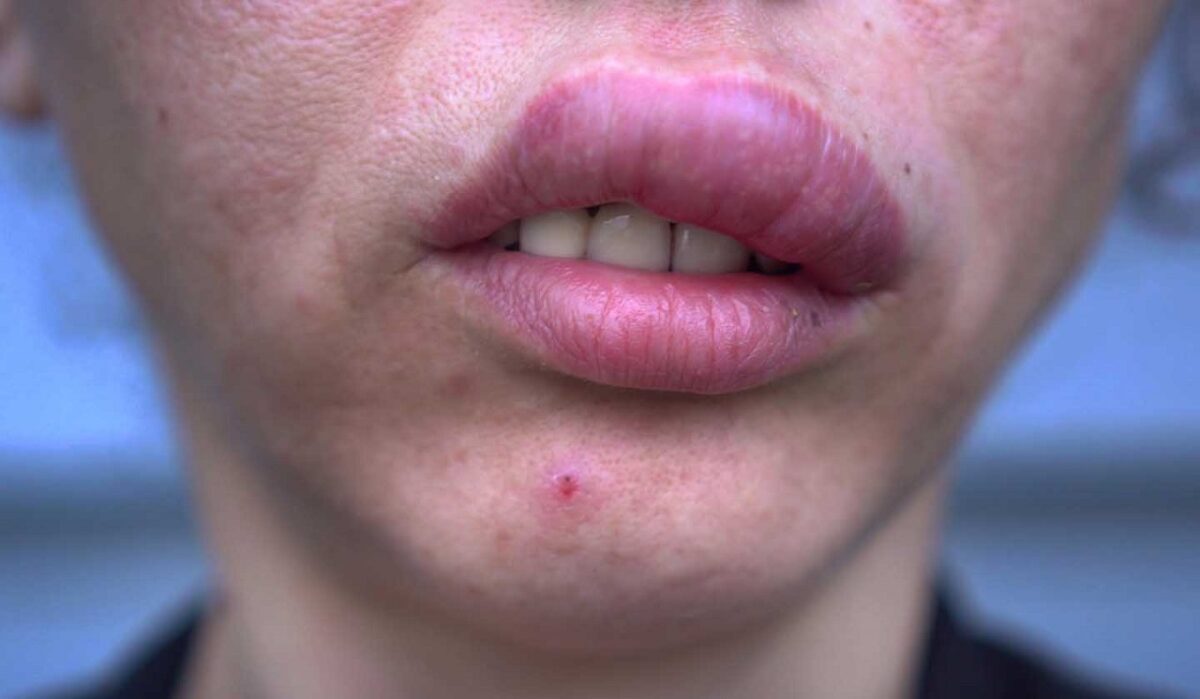 پچ پوستی AllergE