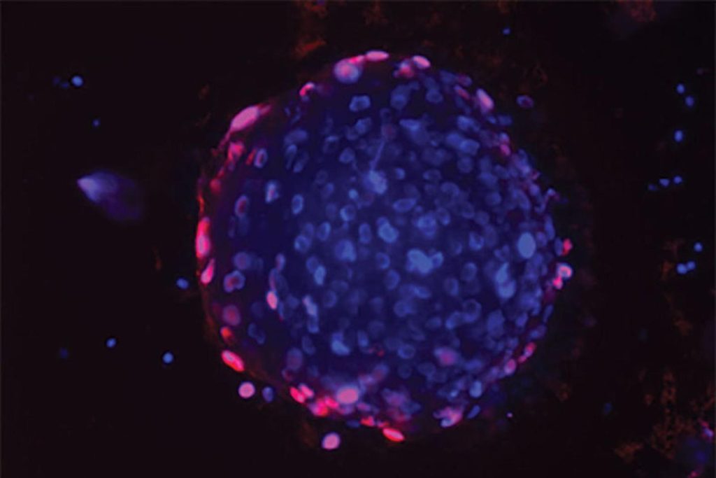 تصویر میکروسکوپی از یک ارگانوئید سرطان پروستات انسانی که با داروی جدید درمان می شود. نواحی قرمز نشان دهنده سلول های مرده است
