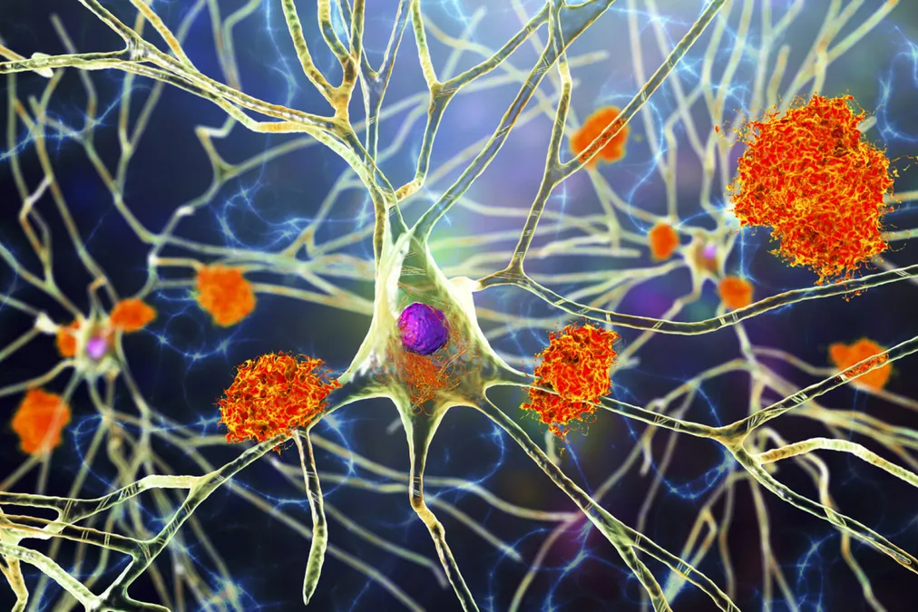 محققان نحوه تجمع پروتئین های سمی در مغز را در مراحل اولیه بیماری آلزایمر با استفاده از روشی منحصر به فرد از ریاضیات نشان دادند.