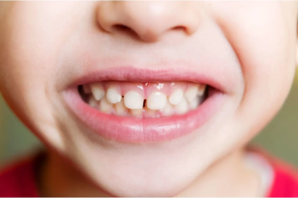 مطالعات نشان می دهد داروهای مسکن رایجی که توسط کودکان مصرف می شوند، ممکن است به مینای دندان آنها آسیب های جدی وارد کند.