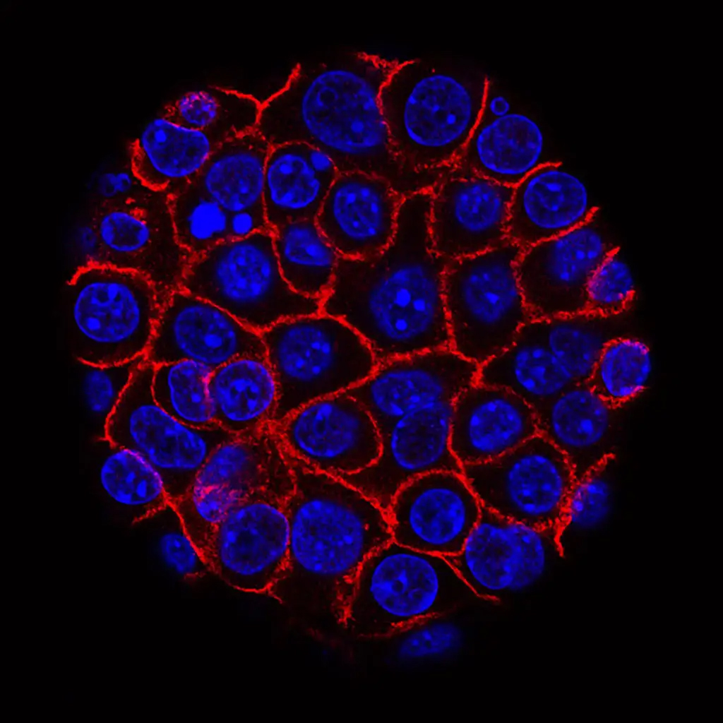 سلول های سرطانی پانکراس (هسته ها به رنگ آبی) به صورت کره ای که در غشاهای در حال رشد (قرمز)  نشان داده می شوند