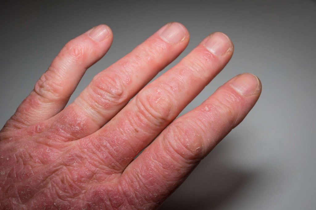 آرتروز پسوریاتیک (PsA)، یک بیماری خود ایمنی است که مفاصل و پوست را تحت تاثیر قرار می دهد. علت این بیماری ناشناخته است.