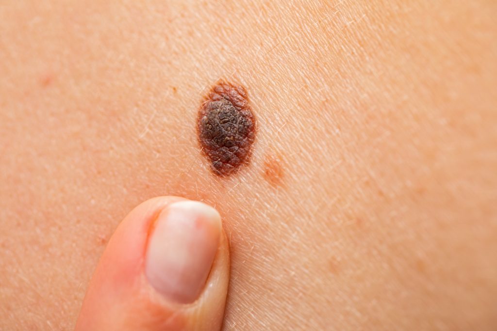 گاهی خال های پوستی بر اثر عواملی از جمله اشعه ماوراء بنفش (UV) دچار تغییراتی می شود که ممکن است نشانه ای از بروز سرطان پوست ملانوما باشد.