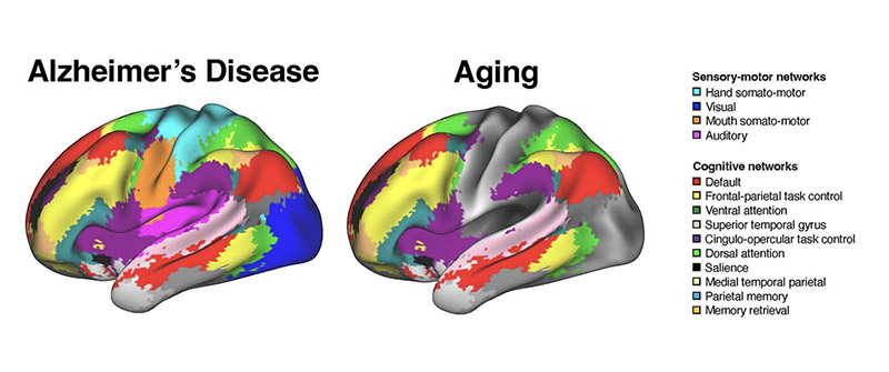 بیماری آلزایمر و پیری با الگوهای متمایز از اختلال در شبکه‌های مغزی مرتبط بودند.