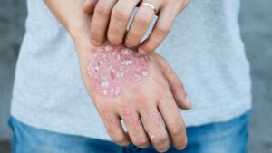 محققان به‌تازگی راهی برای تعدیل سیستم ایمنی به منظور درمان بیماری های پوستی خود ایمنی مانند پسوریازیس یافته اند