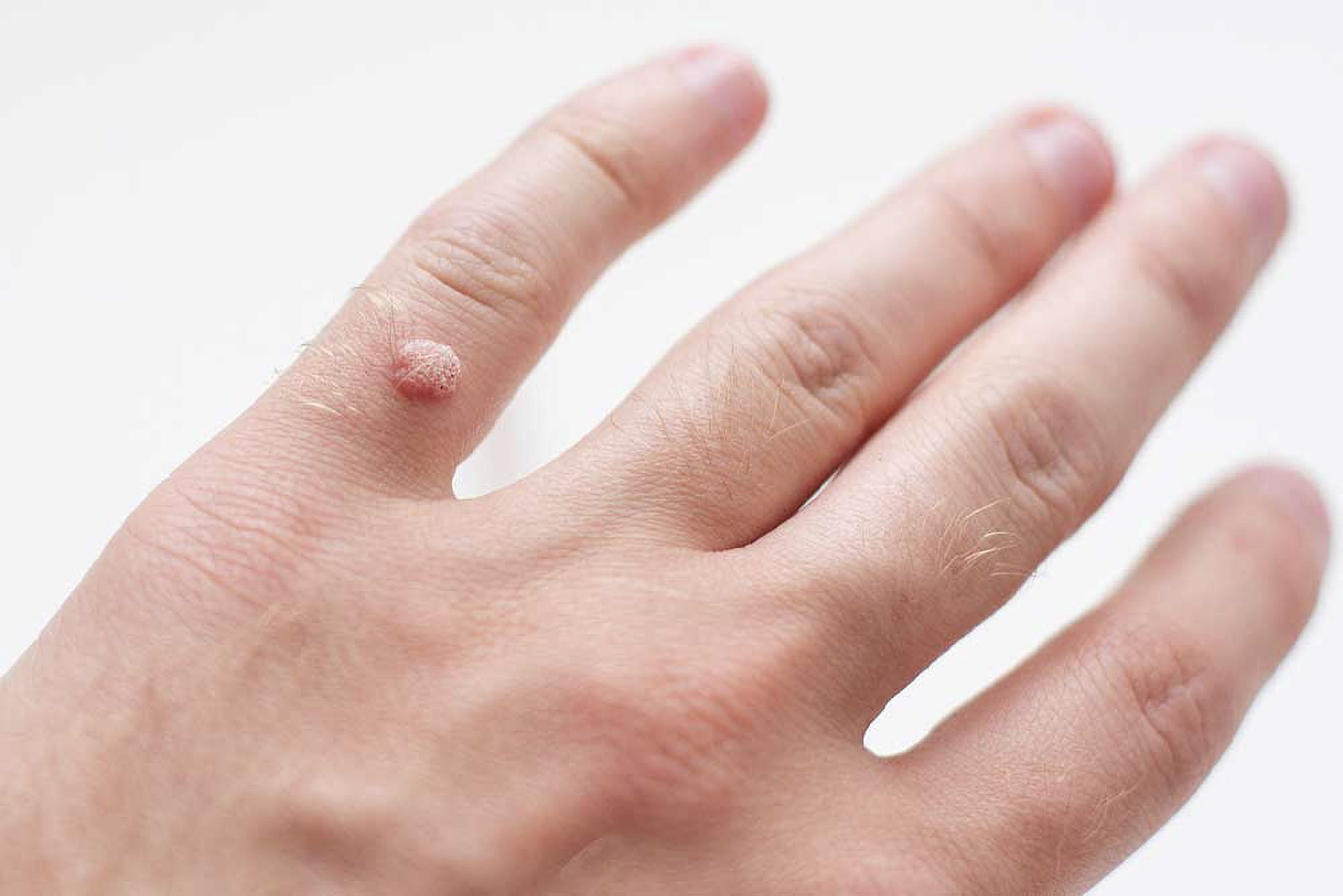زگیل&zwnj;ها توده های پوستی غیر سرطانی هستند که در اثر عفونت ویروس پاپیلومای انسانی (HPV) ایجاد می شوند. بیش از 100 نوع HPV وجود دارد، اما تنها تعداد کمی از آنها باعث ایجاد زگیل می شوند.