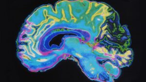 بررسی ام‌آر‌آی‌های مغز محققان را قادر به شناسایی امضای زوال عقل کرده است