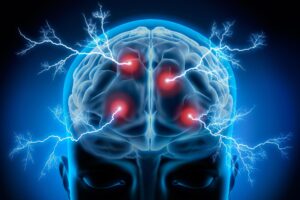 شوک درمانی الکتریکی (ECT) یک درمان موثر برای افسردگی است که احتمالاً به دلیل افزایش فعالیت دوره ای مغز موثر است. تحقیقات اخیر بینش هایی را در مورد مکانیسم این روش ارائه می دهد و راه را برای بهبود درمان های سلامت روان و درک بهتر فعالیت مغز هموار می کند.