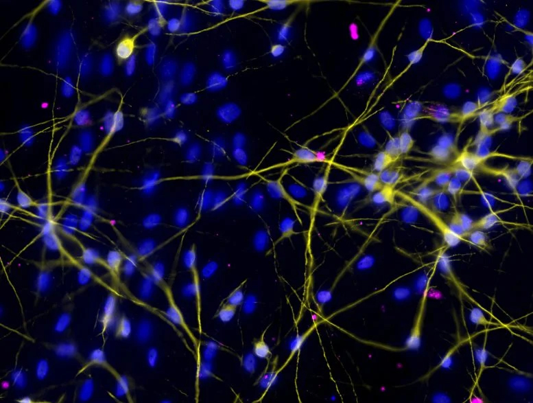 نورون‌های انسانی کشت شده آلوده به ZIKV-LAV. در تصویر عفونت به رنگ صورتی و هسته سلولی به رنگ آبی نشان داده شده است)