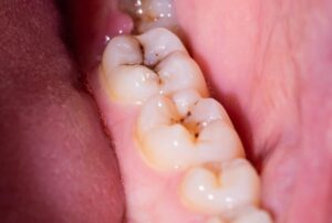 تحقیقات جدید نشان می‌دهد که دیامین فلوراید نقره (SDF) به اندازه سیلانت‌های دندانی در جلوگیری از پوسیدگی دندان در بین بیش از 4000 دانش‌آموز دبستانی مؤثر بوده است و فرآیند استفاده کمتر و سریع‌تری را ارائه می‌دهد. این درمان جایگزین نه تنها از ایجاد حفره جلوگیری می‌کند، بلکه یک اقدام قابل توجه در صرفه‌جویی در هزینه است که می‌تواند دسترسی به مراقبت‌های دندانی را افزایش دهد