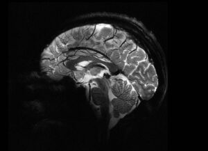 تصویری از مغز انسان که با دستگاه جدید Iseult MRI با قدرت 11.7 تسلا گرفته شده است و جزئیات ممکن را در سطح بالا نشان می‌دهد