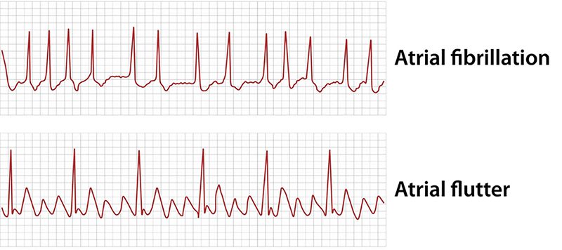 ECG که نشان دهنده فیبریلاسیون دهلیزی (AF) و اختلال ریتم نزدیک آن یعنی فلوتر دهلیزی میباشد