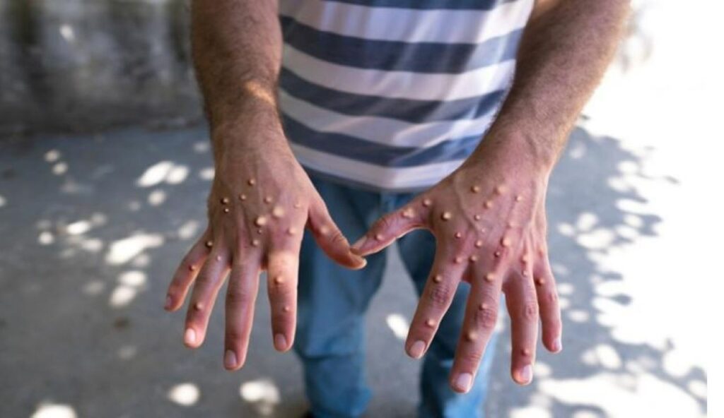 قرنطینه شخصیسازی شده برای مدیریت بهتر بیماری آبله میمونی پیشنهاد شد