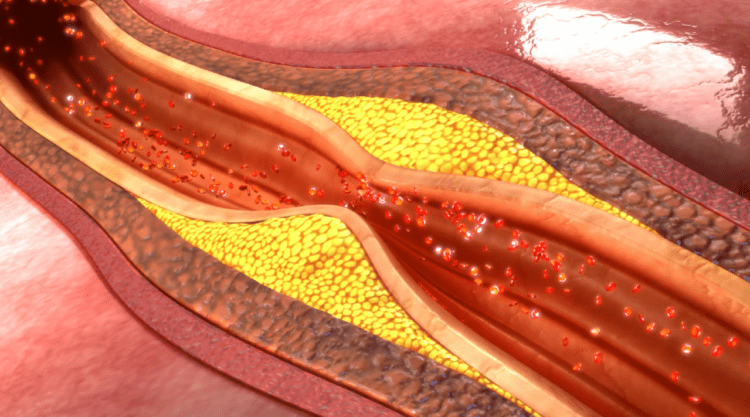 جلوگیری از حملات قلبی با تجزیه پلاک های خونی با نانوذرات