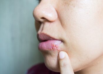 ویروس تبخال می تواند باعث بیماری های عصبی شود