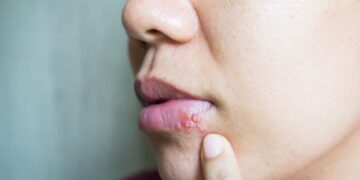 ویروس تب‌خال می‌ تواند باعث بیماری ‌های عصبی شود