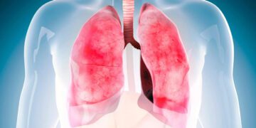 این ماده در شربت‌های سرفه فیبروز ریوی را درمان می کند