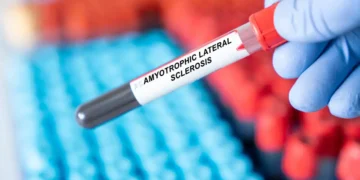 تشخیص دقیق ALS با آزمایش خون جدید