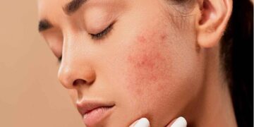 علت بروز جوش و آکنه در بزرگسالی چیست؟